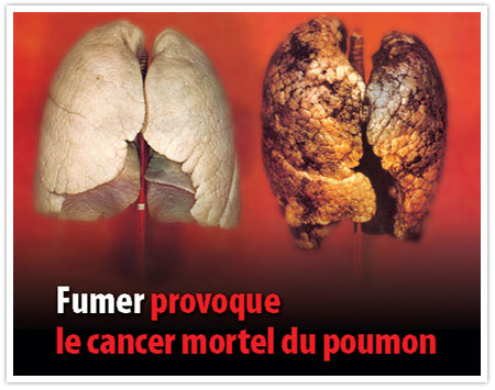 Cancro do Pulmao.png